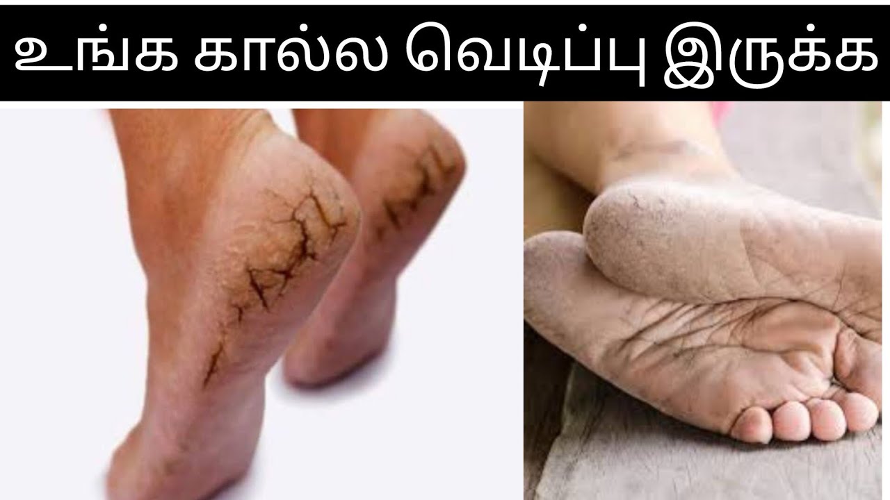 Foot Cream review in tamil | கால் வெடிப்பு இருக்கா 