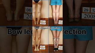 Bow Legged Correction