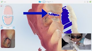 Chairside Live  Episode 269: Picture This: Capturing Interproximal Contacts