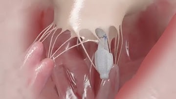 PASCAL repair system features - Elongation in the subvalvular apparatus | Animation