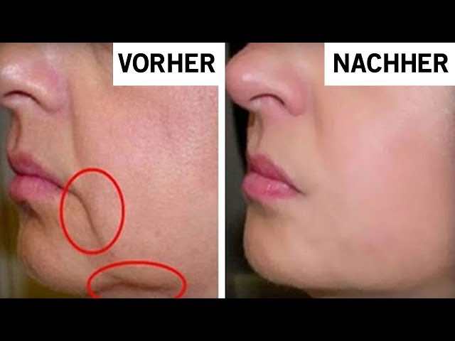 Nachher gesichtsgymnastik vorher Gesichtsgymnastik