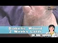 Diabetic Wound 2 Weeks Later