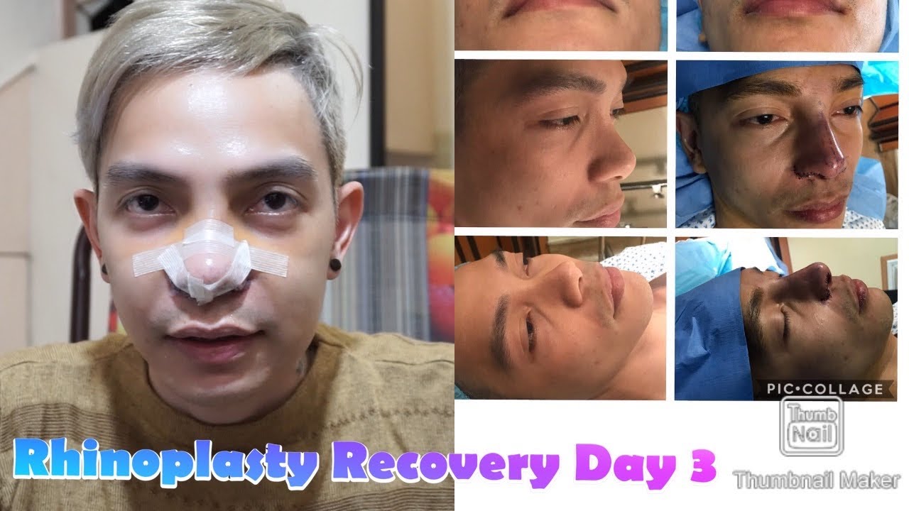 Rhinoplasty Recovery Day 3 - YouTube