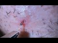 Plucking facial hair & ingrown hair 763 頬髭抜き(埋没毛あり)