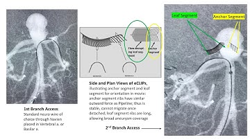 ECLIPs Deployment and coiling in basilar tip aneurysm