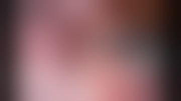 Robotic left S1-3 trisegmentectomy