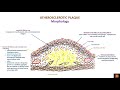 atherosclerosis morphology and consequences