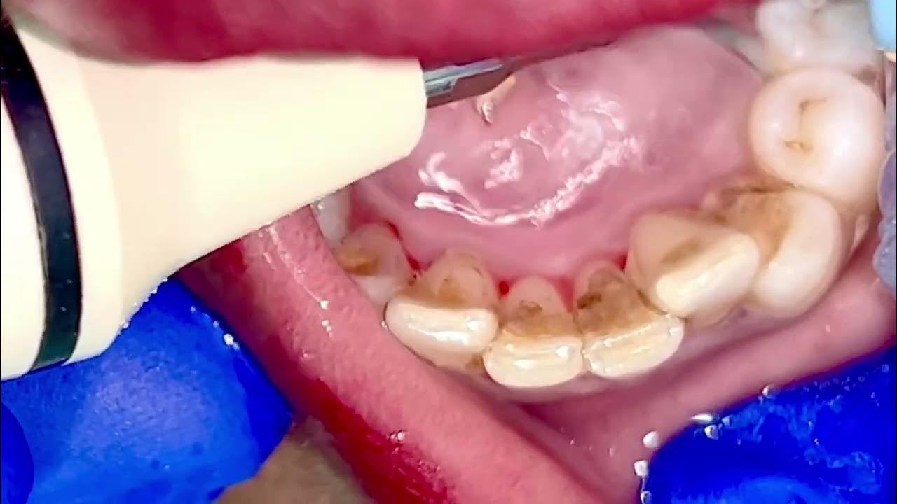Scaling tartar buildup from teeth YouTube
