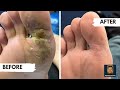 Treatments for Plantar Warts