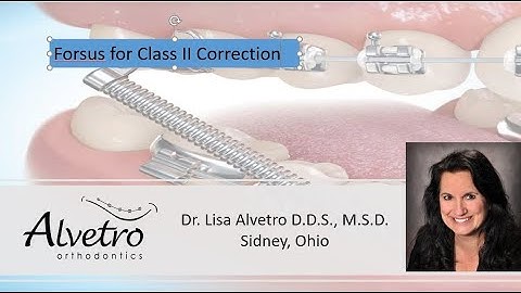 Installation of the Forsus Class II Corrector