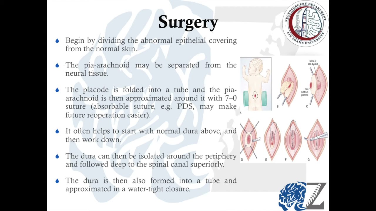 Spina Bifida and Myelomeningeocele  (Part 3) تشقق العمود الفقري و الكيس السحائي النخاعي