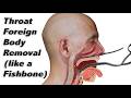 How a Fishbone (or Other Foreign Body) is Removed from the Throat Without Sedation