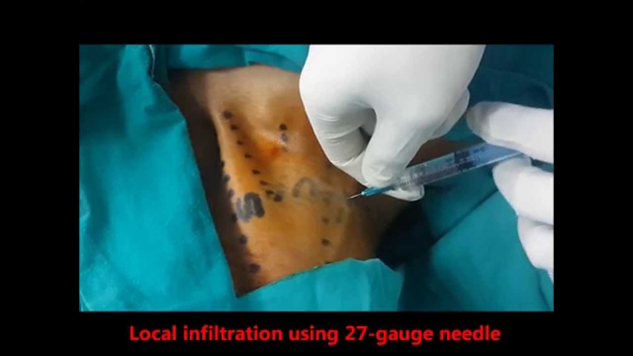 Low approach interscalene block (ISB) using PNS camera iphone 8 plus apk