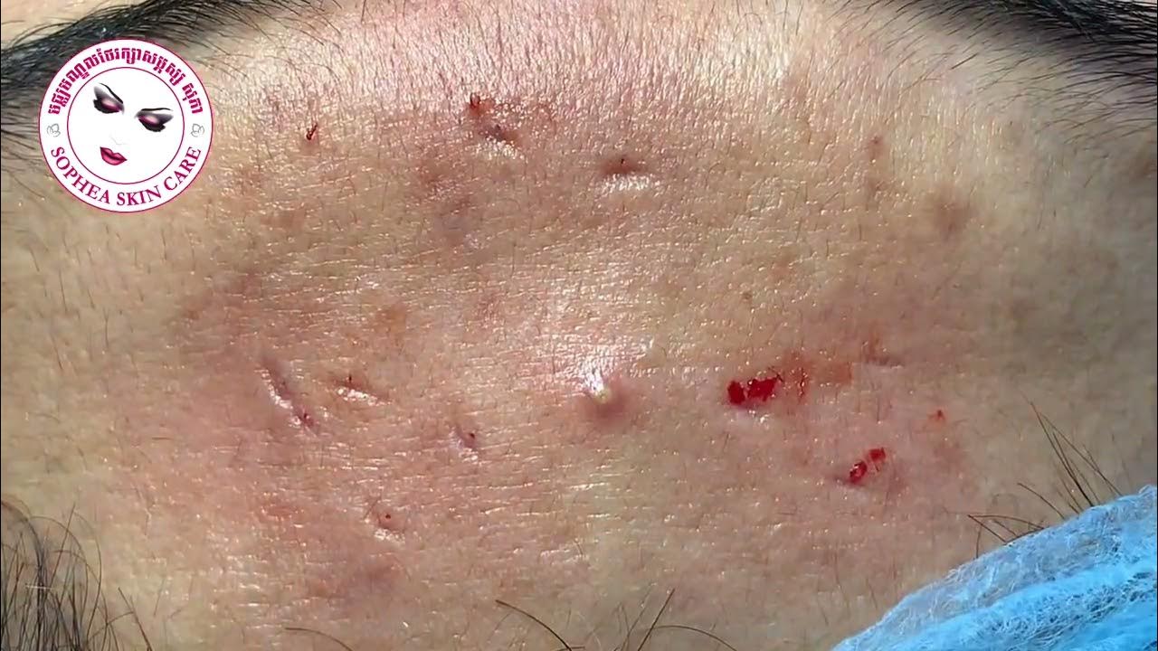 acne removal facial treatment by sopheaskincarecambodia clinic 05 March