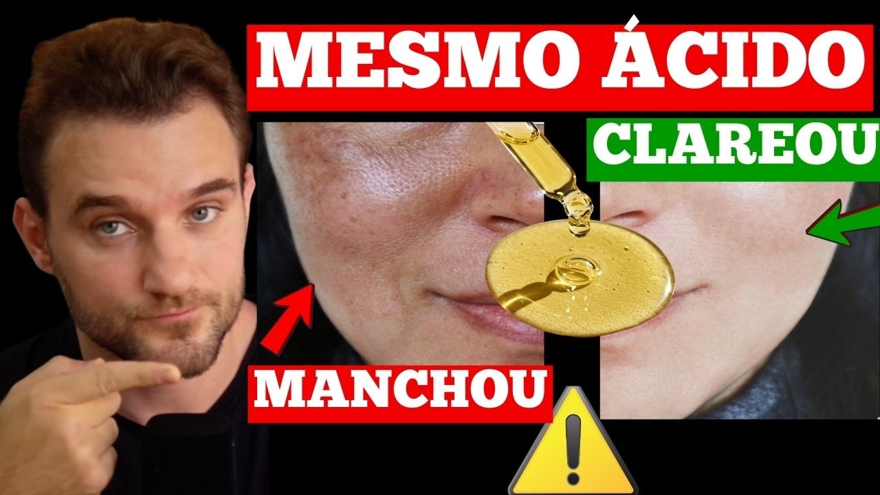 RETINOL, VITAMINA C E ÁCIDOS: PELE PERFEITA (PARA ALGUMAS PESSOAS)