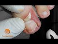Ingrown toenail #podologiaintegral