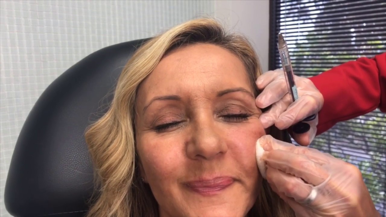 Dermal Filler Cheeks and Jawline