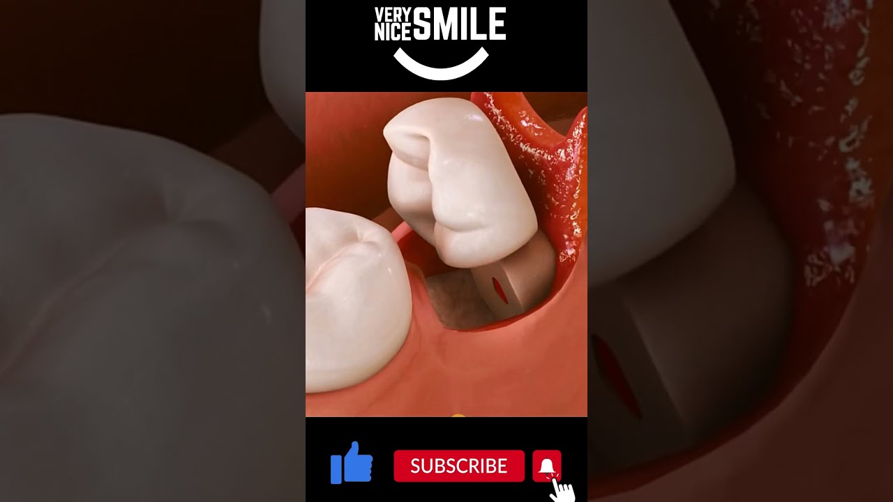 Impacted Wisdom Tooth Removal Shorts