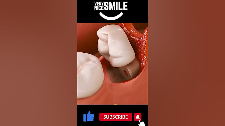 Impacted wisdom tooth removal #shorts