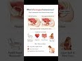RectovaginalEndometriosis:#RectovaginalEndometriosis#DeepInfiltratingEndometriosis#endo#shorts#viral