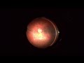 Combined surgery for pseudophakic retinal detachment