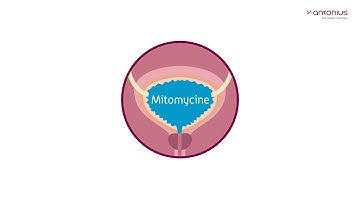 Mitomycine blaasspoeling bij blaaskanker | St. Antonius Ziekenhuis