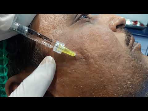 acne scar treatment by filler lahore pakistan/ Dr Amin Yousaf Plastic Surgeon