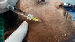 acne scar treatment by filler lahore pakistan/ Dr Amin Yousaf Plastic Surgeon