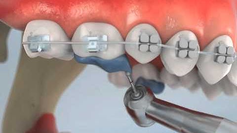 Deep Bite Posterior Turbos