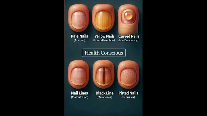 Find out deficiency diseases from nails. 💅🔍 #Nails #Deficiency #Diseases #medical #medicine