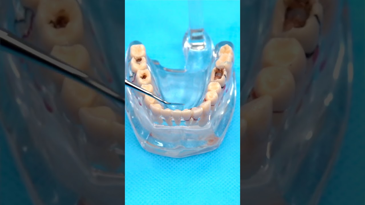 Профилактика кариеса: фторирование зубов — ZemsClinic.ru 