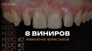 Изменение формы зубов. Виниры. Шиловидные зубы | Прокопович Виктор.