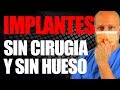 LA MEJOR OPCIÓN PARA REEMPLAZAR TODOS TUS DIENTES (aunque no tengas hueso y le temas a la cirugía)