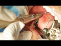 Super Smooth Dental Implant Surgery - Dr. Sunil Richardson