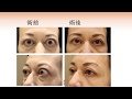 バセドウ病眼症への手術 眼窩減圧術について~バセドウ病眼症を医師が解説! オキュロフェイシャルクリニック東京~鹿嶋友敬