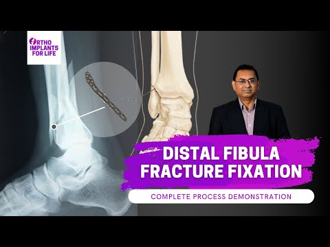 Distal Fibula Fracture