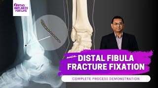 Distal Fibula Fracture and Plate Fixation Procedure
