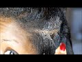 Warning-GROSS! Extreme ECZEMA attack on my scalp. How I recovered