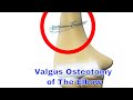 Valgus Knee Deformity - Everything You Need To Know - Dr ...