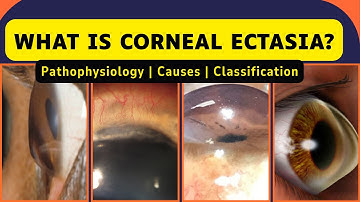 Corneal Ectasia | Pathophysiology, Classification & Biomechanics Made Easy