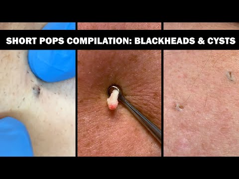 Satisfying Short Pops Compilation | Blackheads & Cysts | CONTOUR DERMATOLOGY