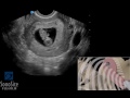 How To: Pathology Ectopic Pregnancy 1st Trimester TV 3D Video