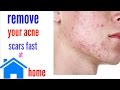 How to Remove Acne Scars Naturally at Home | Best of 2017 | Health Doctor