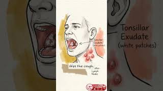 How To Tell Viral From Bacterial Sore Throats | Respiratory How To Tell Viral From Bacterial Sore Throats | Respiratory