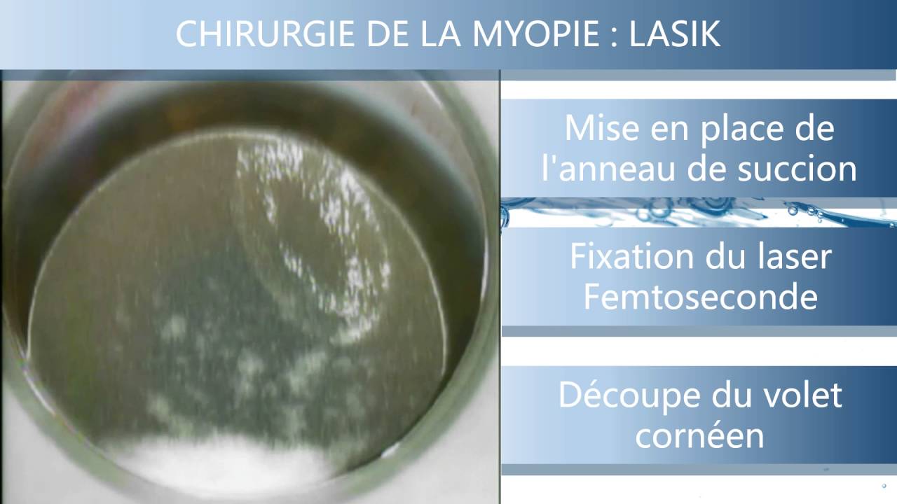 video chirurgie miopie