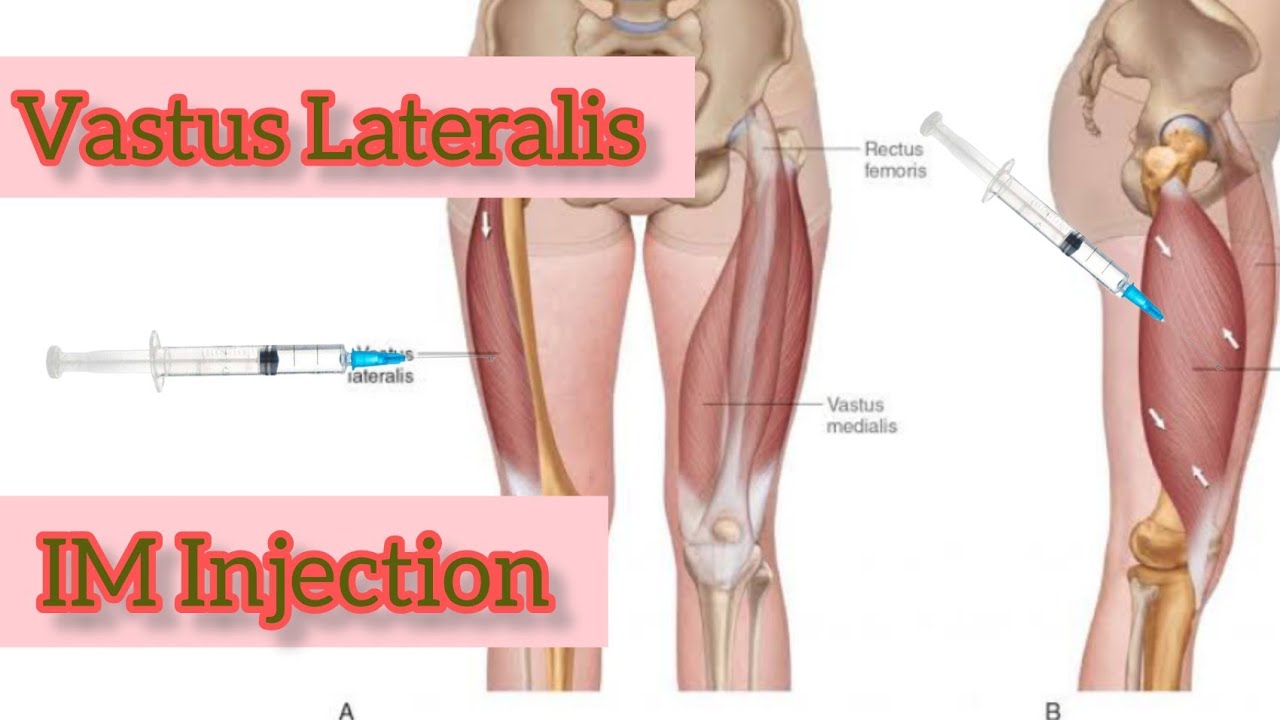 vastus lateralis injection