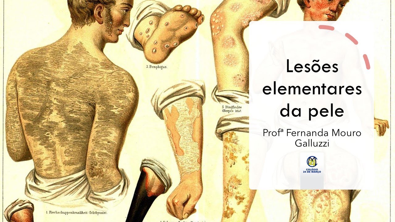 Lesões elementares da pele YouTube Lesões elementares da pele YouTube
