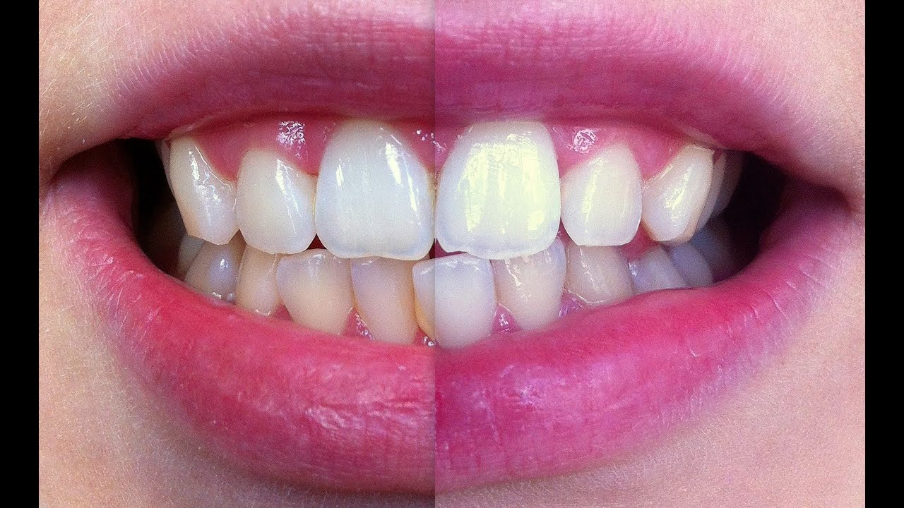 How can you whiten teeth at home?