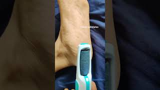 Amazon Callus Remover