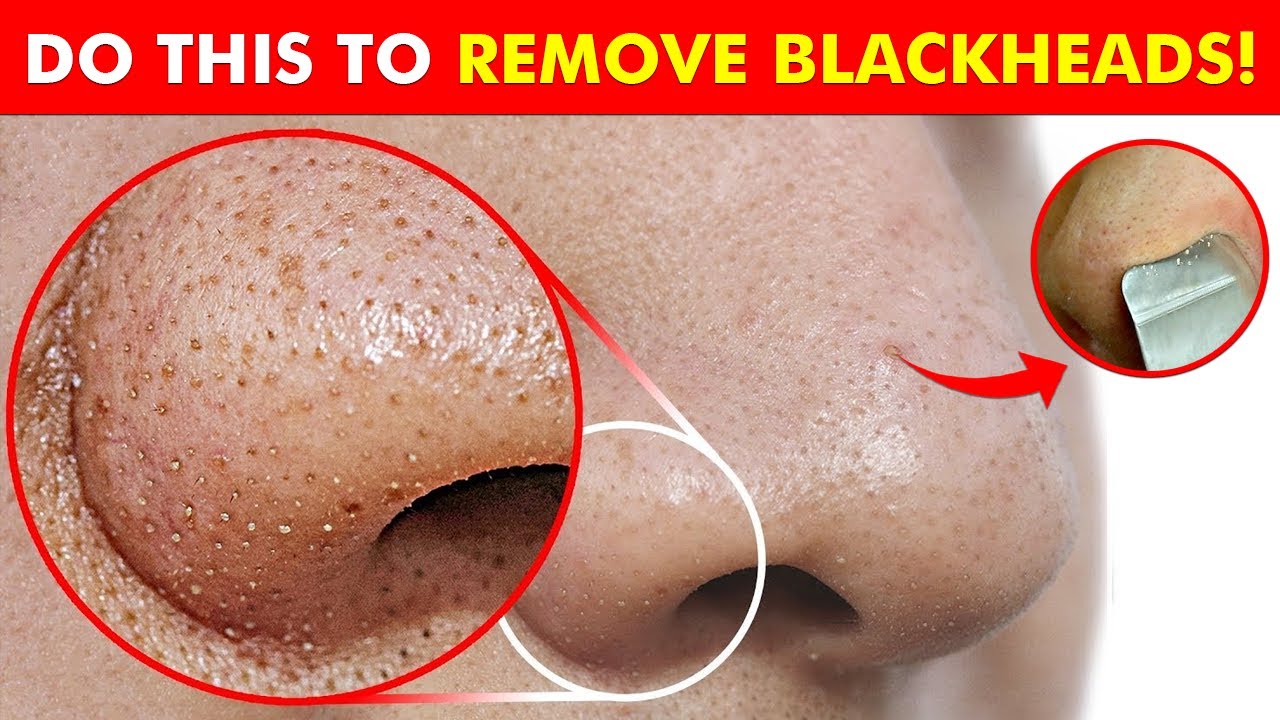 How to Remove Blackheads at Home? 10 DIY Hacks for Perfect Skin